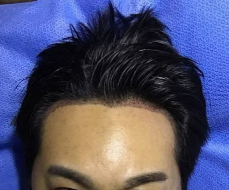 각질제거후.jpg