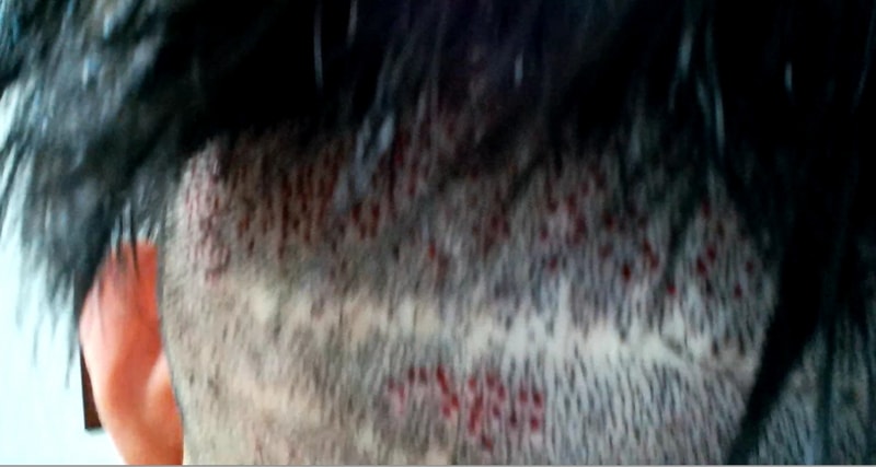 후두부 중간 1.PNG