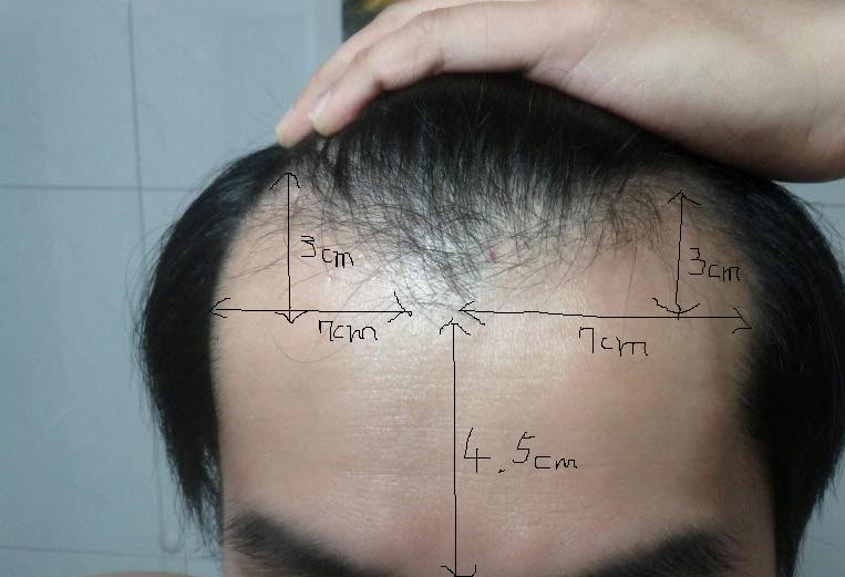 앞이마1센티.JPG