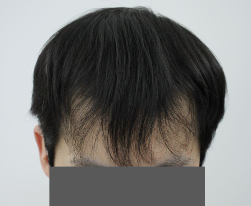 수술 전