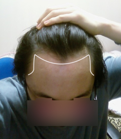 hairline_2.jpg