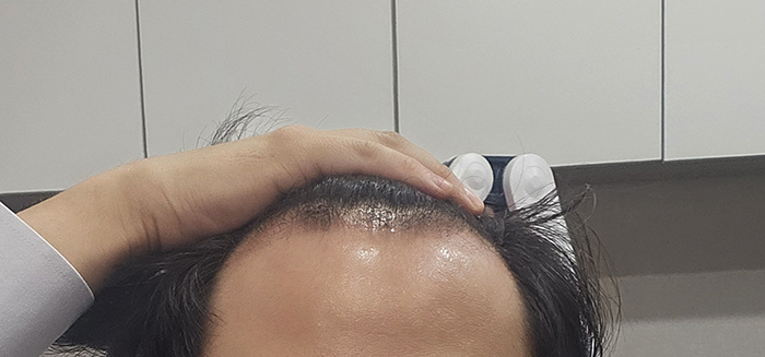 수술1개월