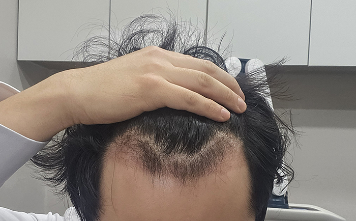 수술1개월