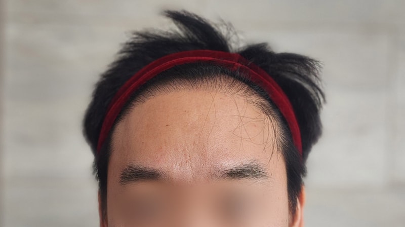 권혁진_모발_240224_수술전_2.jpg