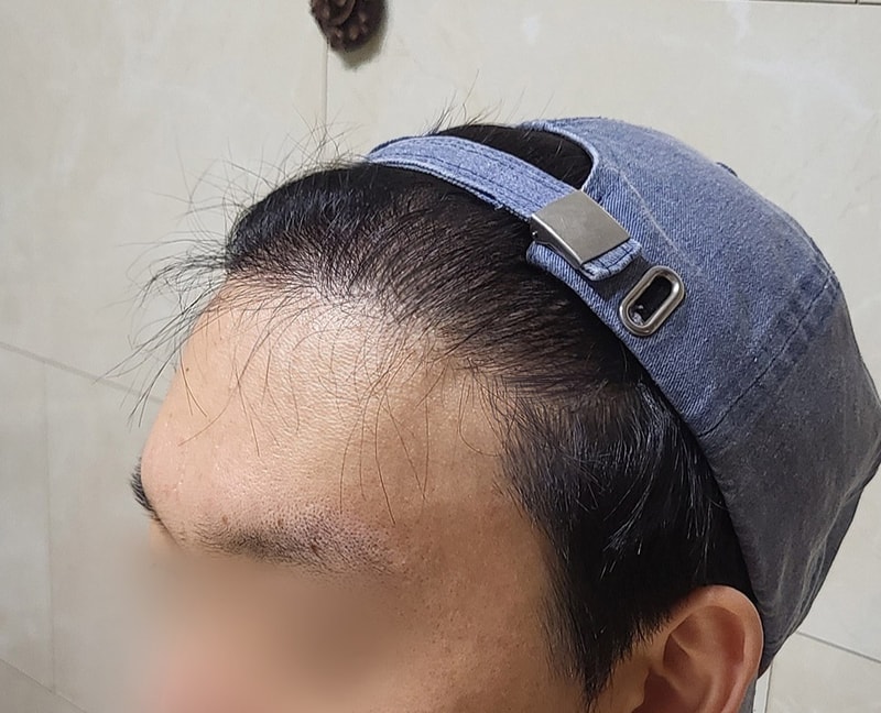 권혁진_모발_240224_수술후6개월_2.jpg