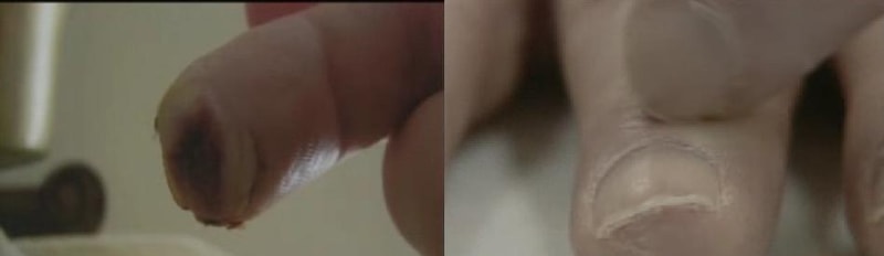 acell_before_after_finger.JPG.jpg