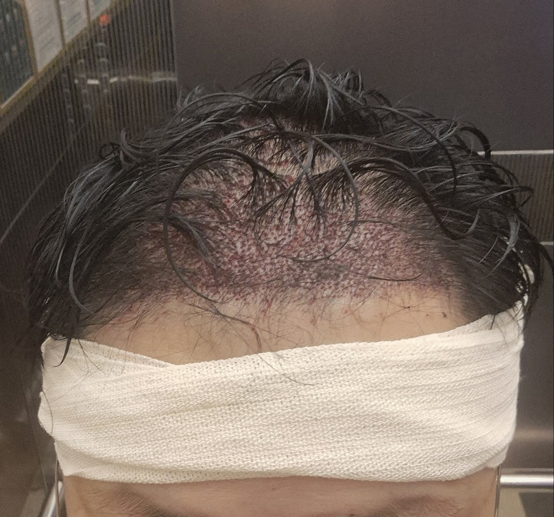 수술당일붕대