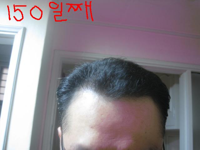 6번 수술후 150일.jpg
