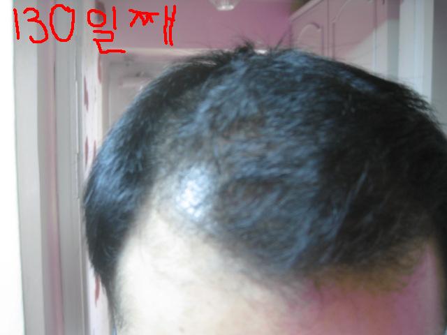 5번 수술후 130일째.jpg