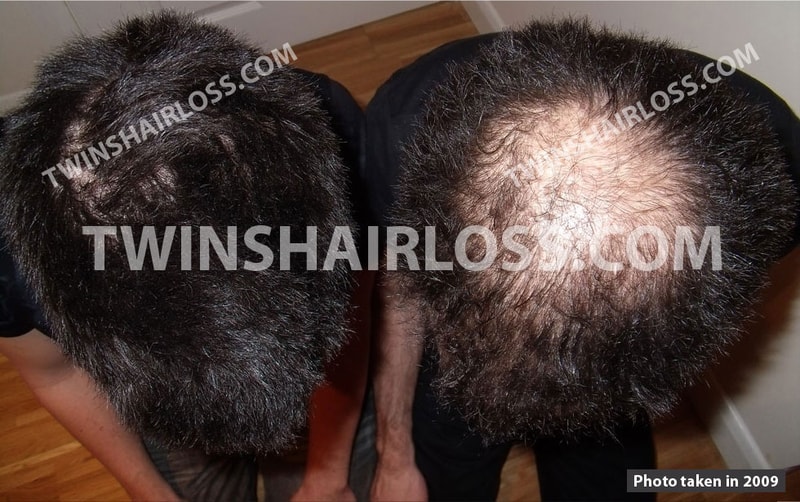dihydrotestosterone-dht-blockers-twins.jpg