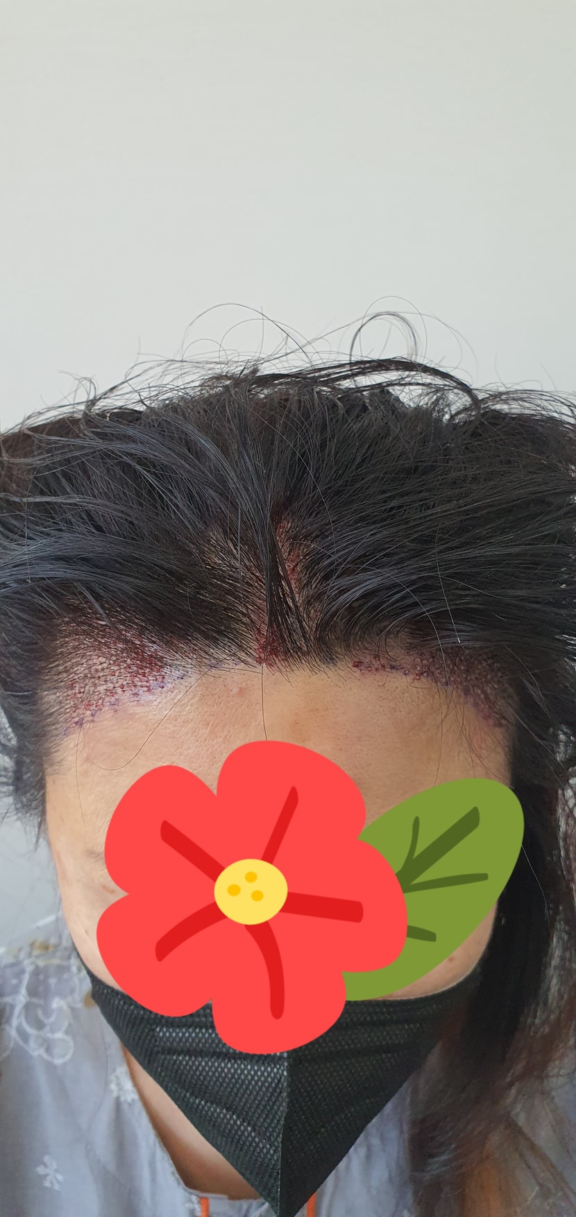 수술직후