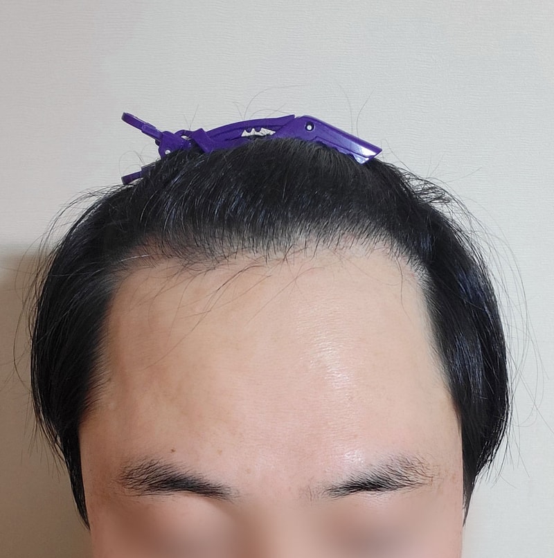 김민환_모발_240319_수술전_1.jpg