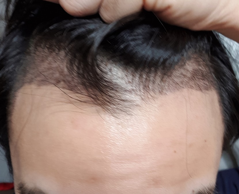 수술 7일후 딱지가 떨어지고 1월 16일