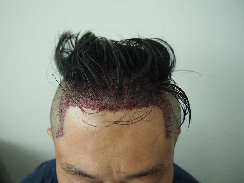 수술후 정면.JPG