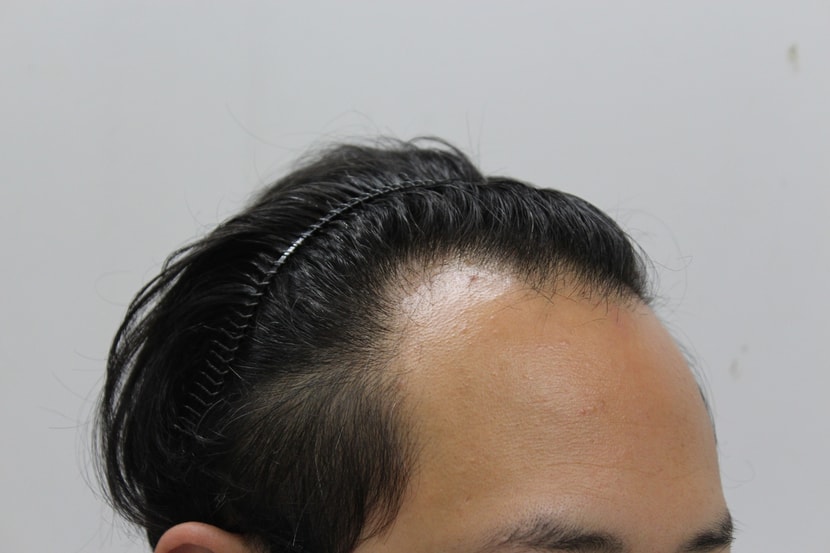 수술 전 3