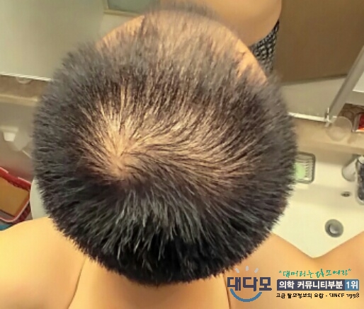 초반 정수리.jpg