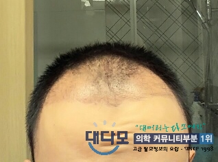 암흑기이마.jpg