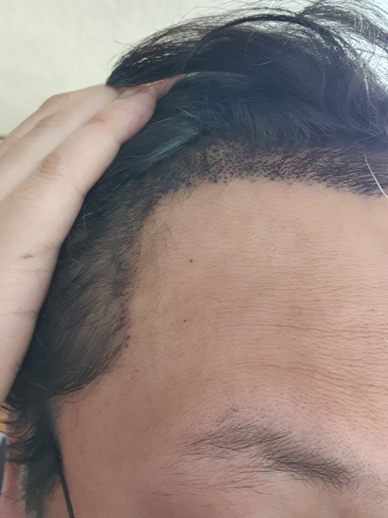 JP성형외과_모발이식_2020_06_07_003.jpg