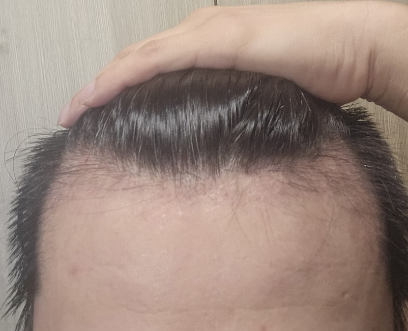 수술전 M자