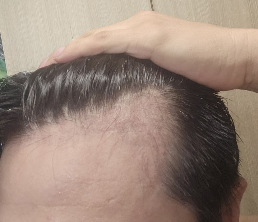 수술전 M자