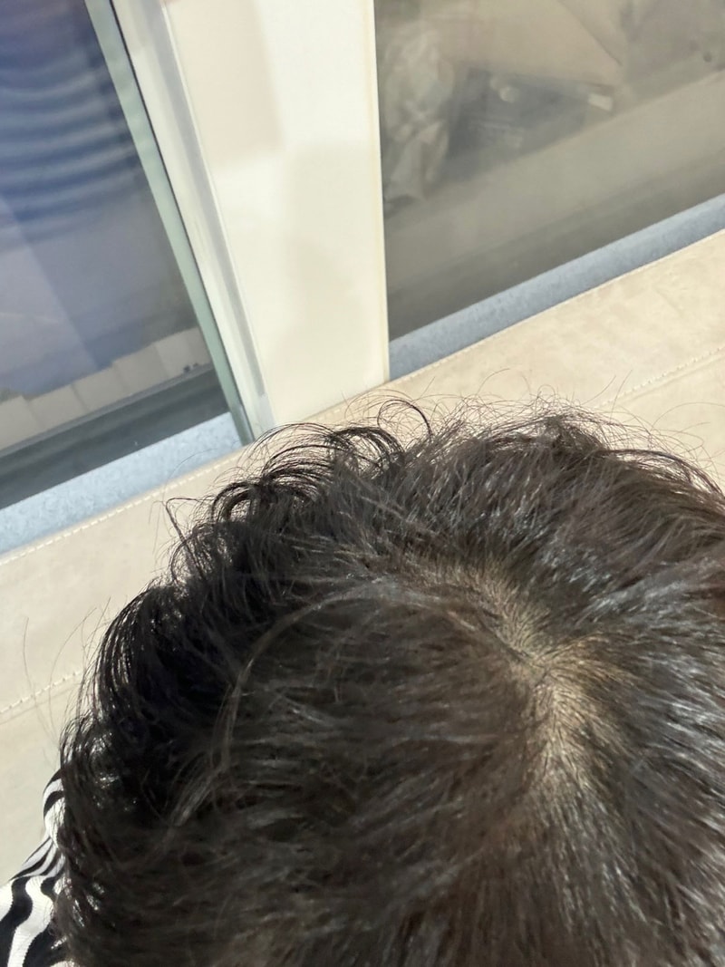 김성민_모발_240228_수술후2주_2.jpg