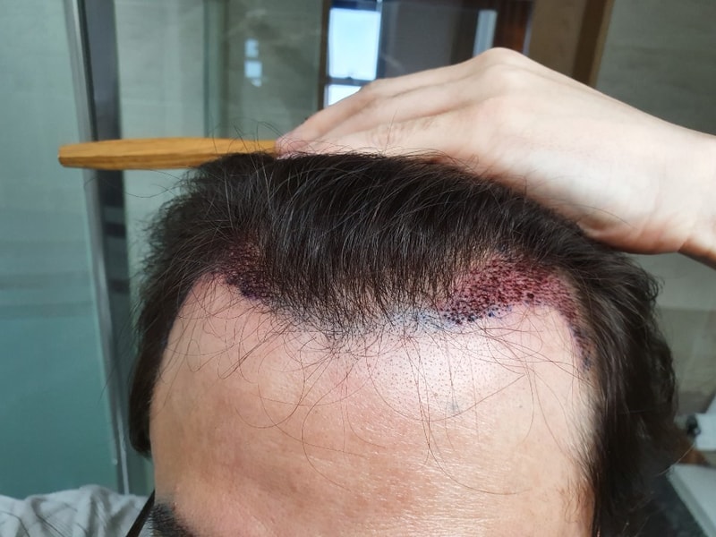 이식4.jpg