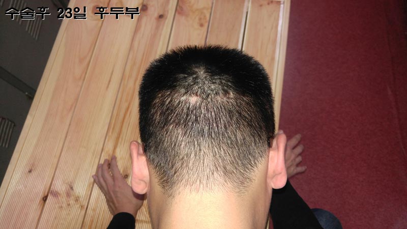 수술후-23일-후두부-2.jpg
