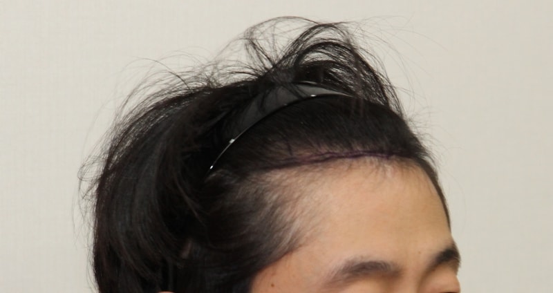 이식 전 오른쪽.jpg