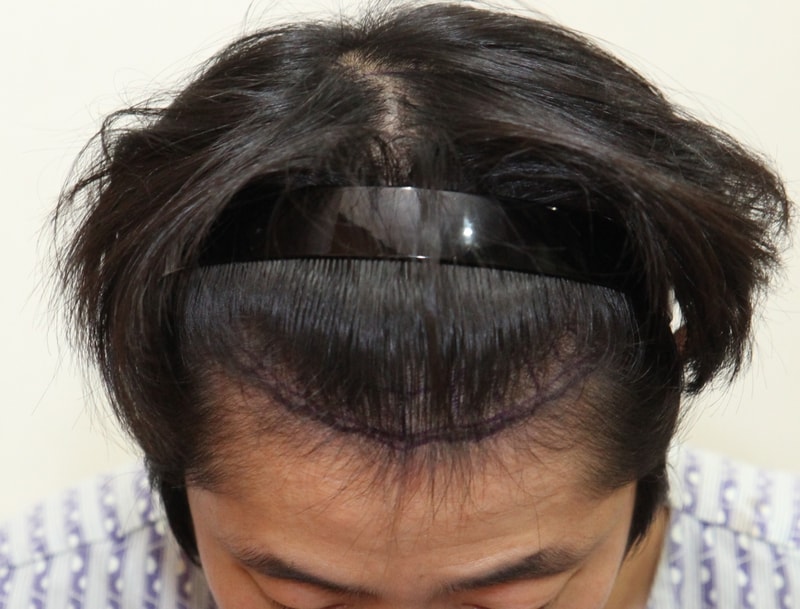 이식전_정면.png