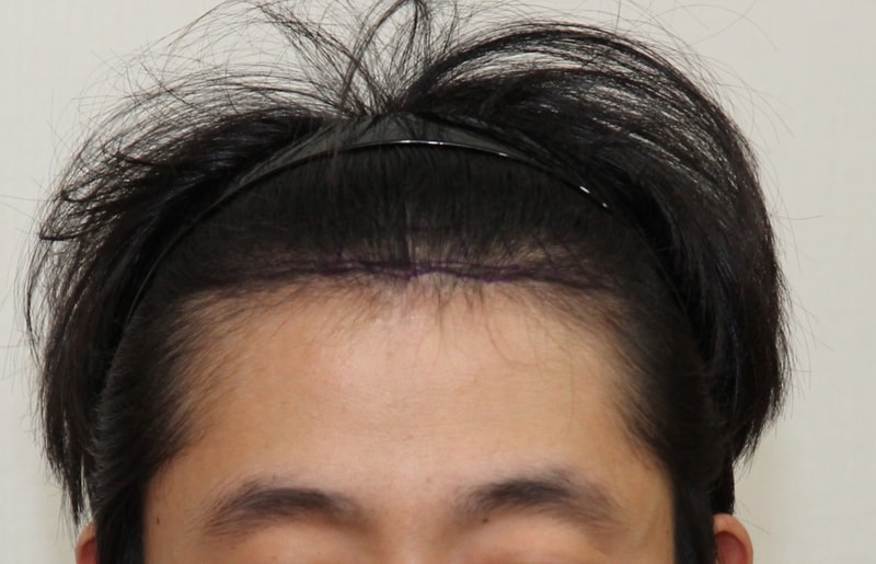 이식전_정면2.png