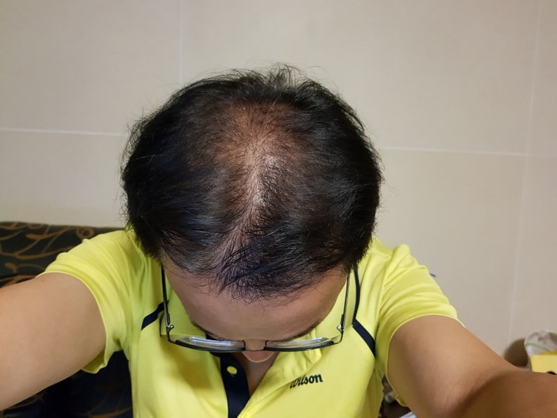수술후 30일 정수리.jpg