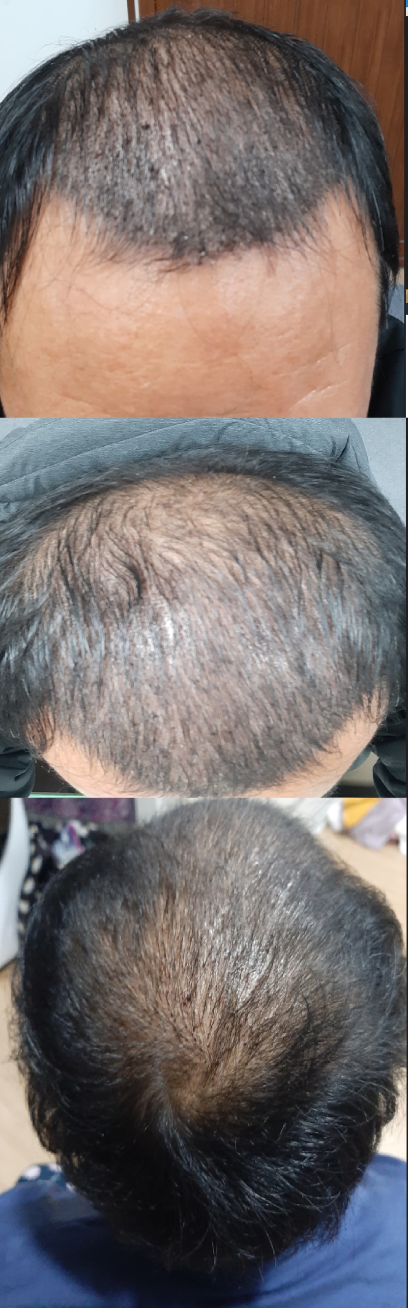 수술 후 10일차 사진 (모자를 오래써서 좀 떡진 사진임을 감안)
