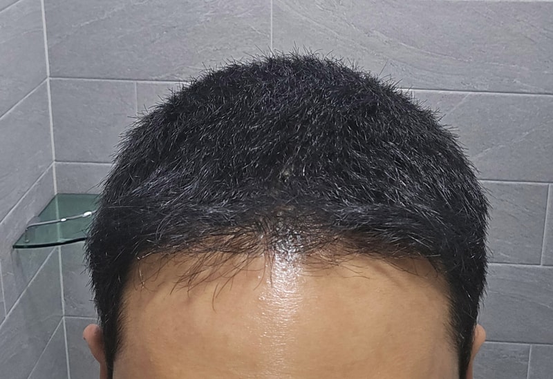 강경민_모발_241123_수술후6개월_1.jpg