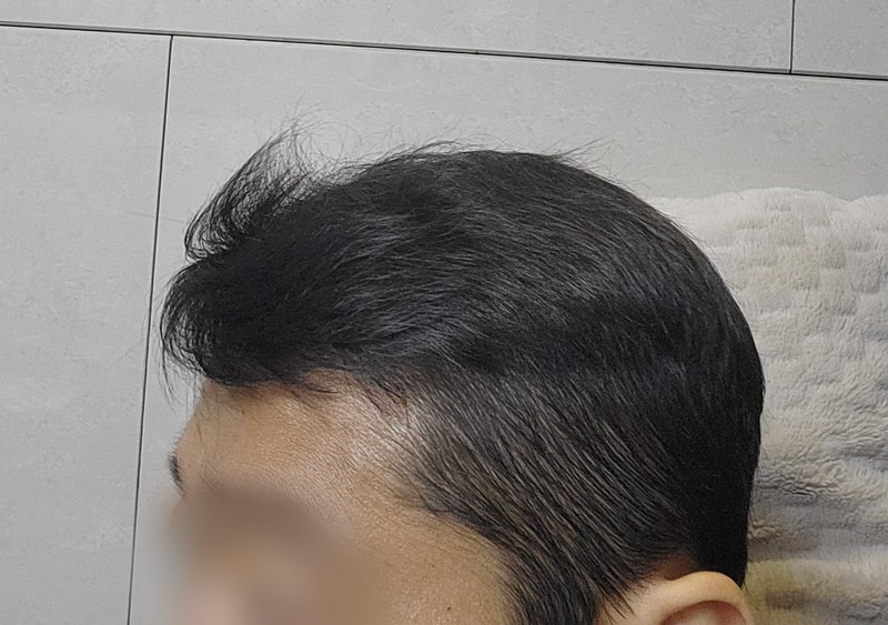 강기태_모발_240120_수술후6개월_3.jpg