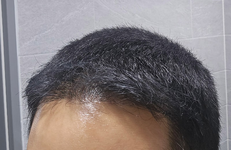강경민_모발_241123_수술후6개월_2.jpg