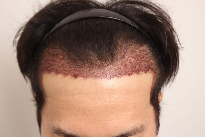 수술다음날 (3) (NXPowerLite).JPG