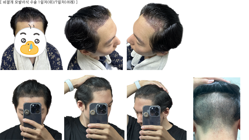 모발이식 1일부터 7일.png