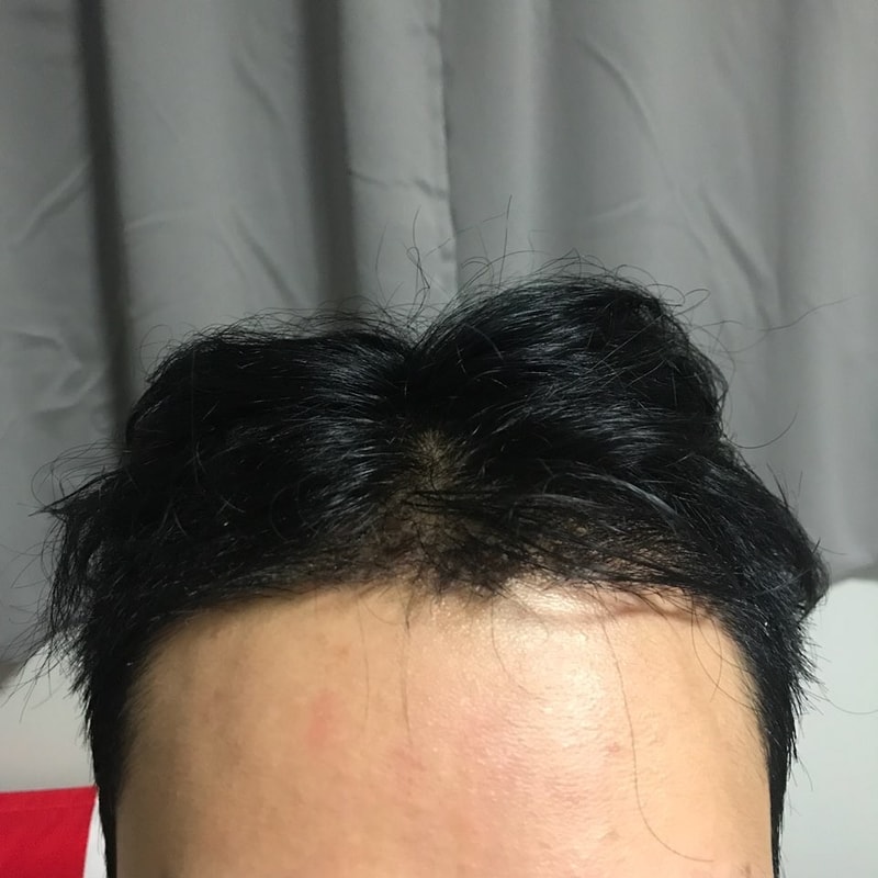 수술2주차.jpg