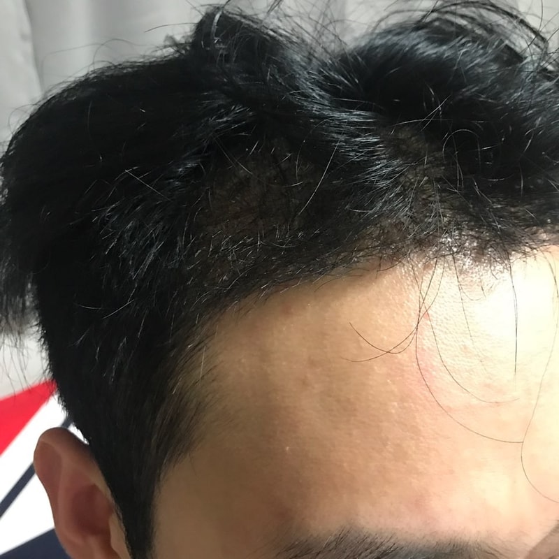 수술 2주차.jpg