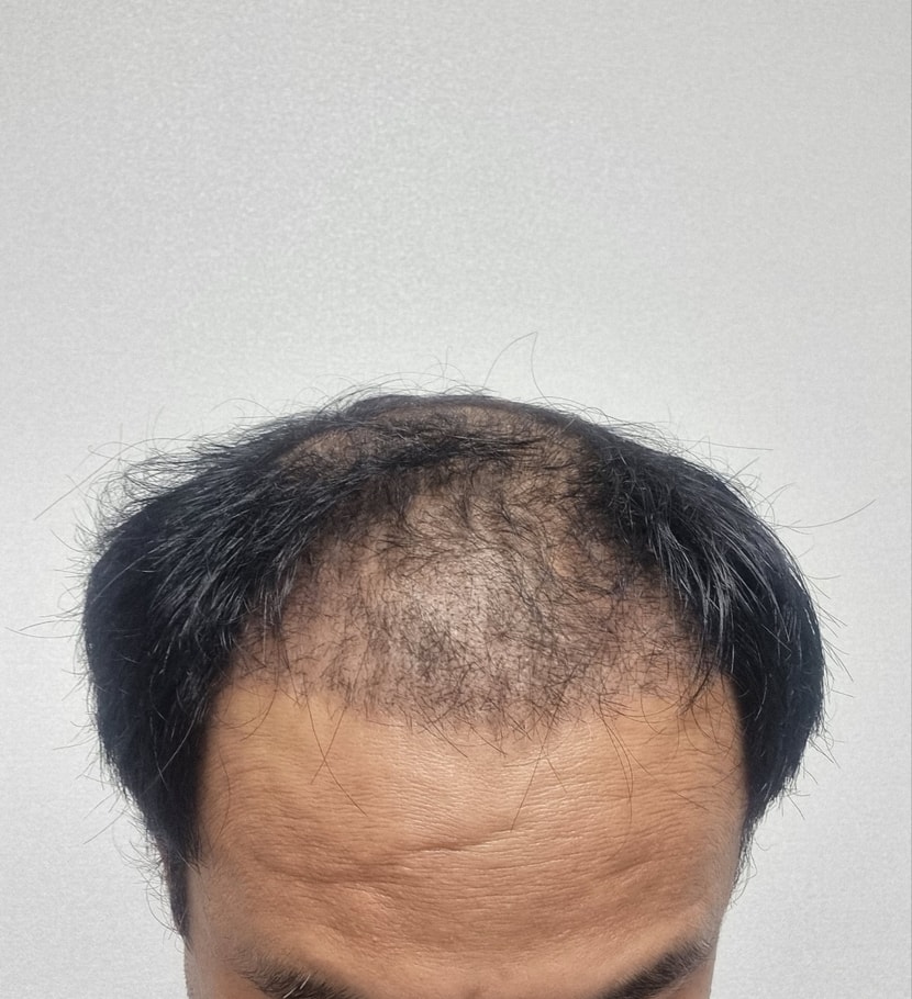 수술 1개월후