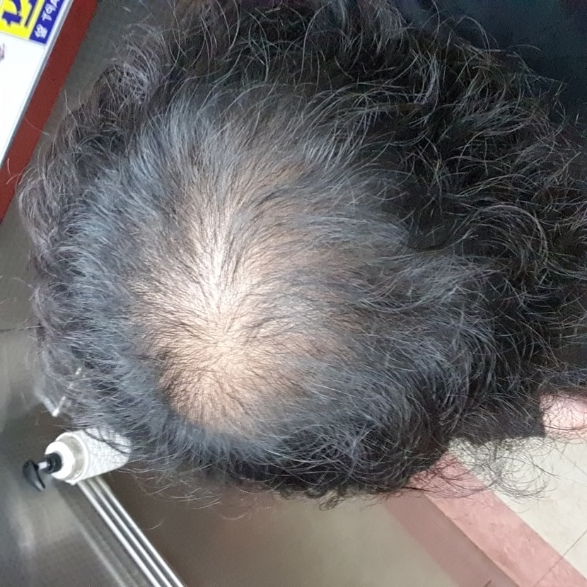 수술 전