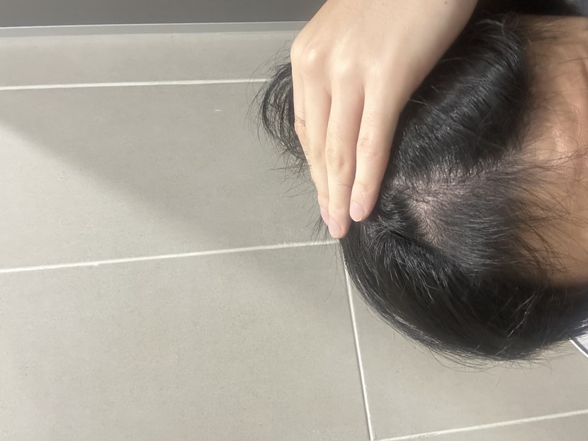 모발이식 후