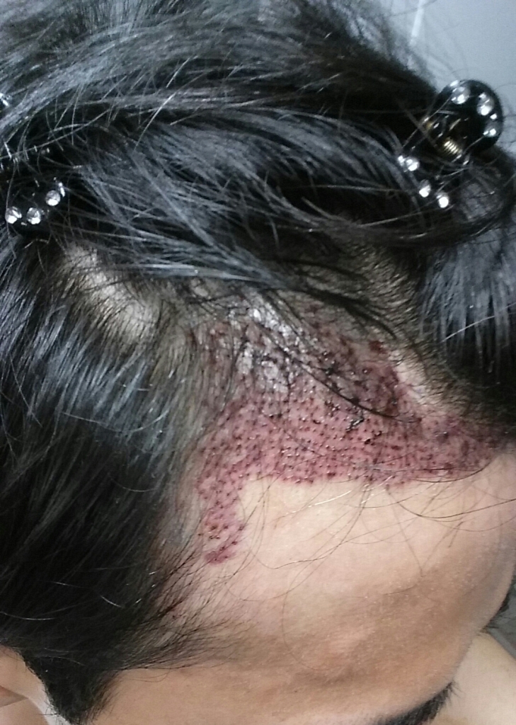 7월16일 수술1일째 우측.jpg