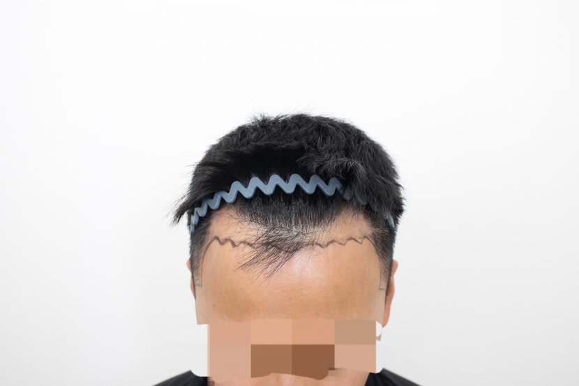 수술 전