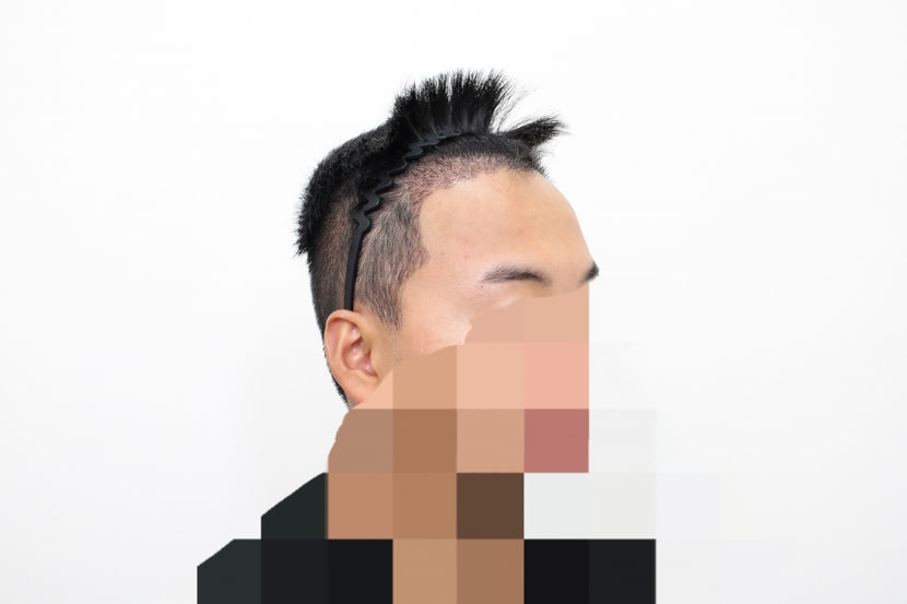 수술 2주 후