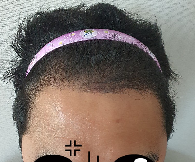 모발이식 후