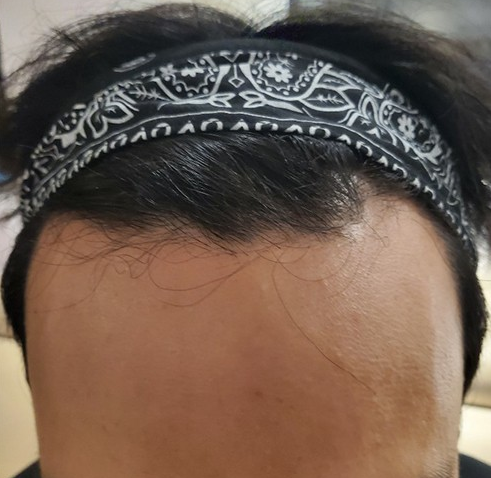 모발이식 전