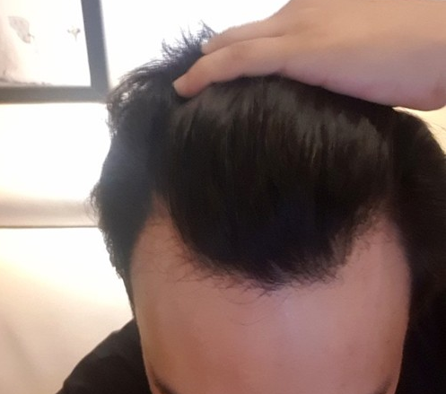 모발이식 전