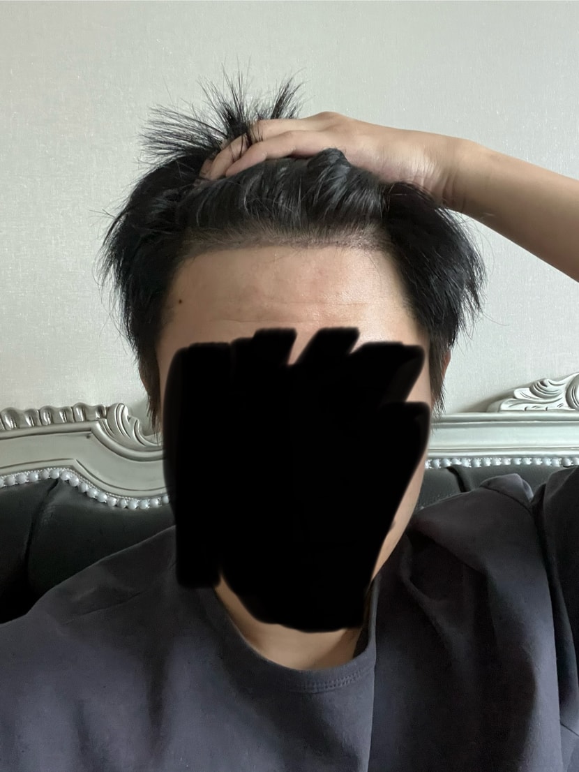 2차 수술후
