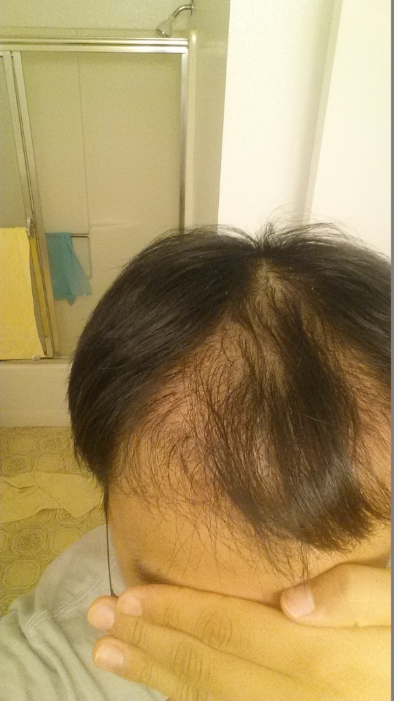 수술76일후.jpg